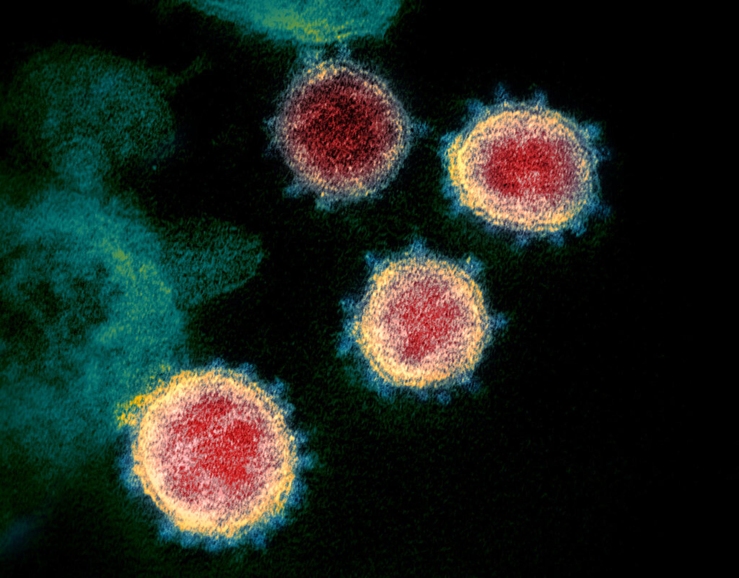 Imagen de microscopio electrónico que muestra el coronavirus que causa la enfermedad COVID-19.