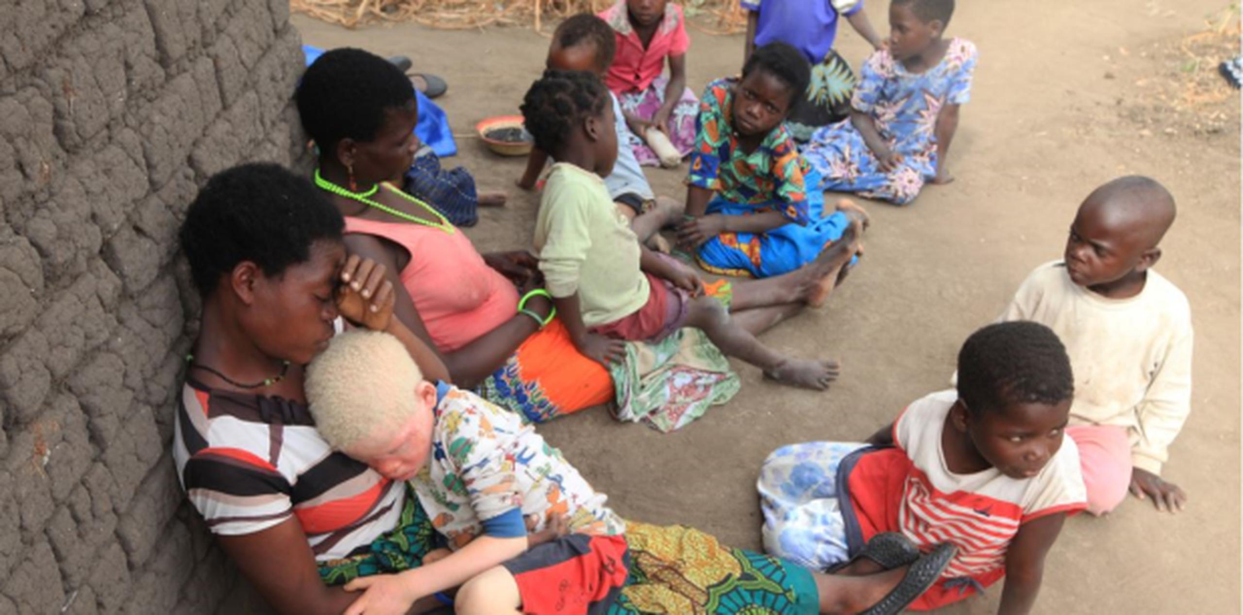 Por lo menos 18 albinos han sido asesinados en Malaui desde noviembre del 2014. (AP)