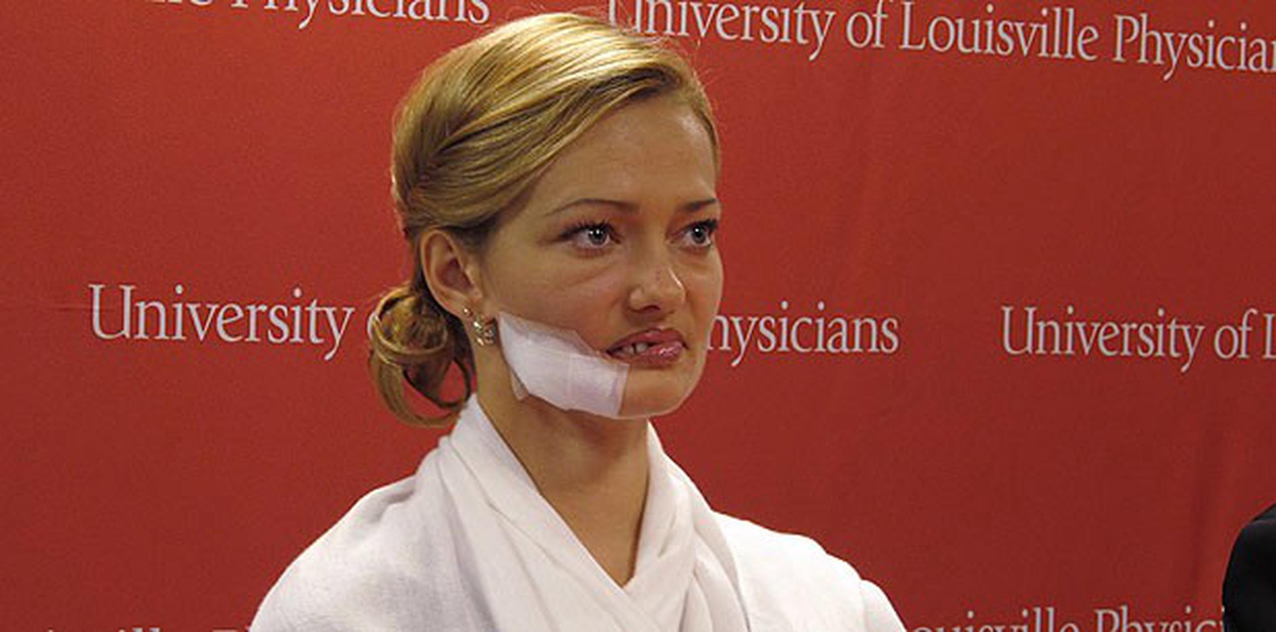 Lessya Kotelevskaya sufrió el rechazo de su esposo y la comunidad cuando su rostro quedó mutilado. (AP Photo/Bruce Schreiner)