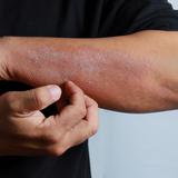 La dermatitis atópica no tiene cura, pero es tratable