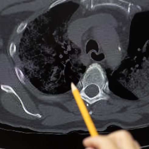 Ciencias Forenses muestra cómo se ven los pulmones tras muerte por COVID-19