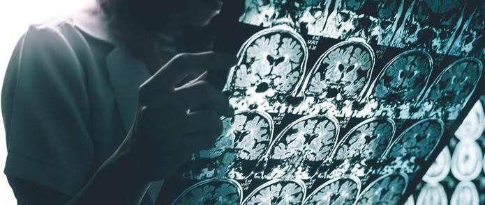 Los biomarcadores más estudiados en la enfermedad de Alzheimer incluyen los estudios de imágenes del cerebro, como resonancia magnética (MRI). (Shutterstock)