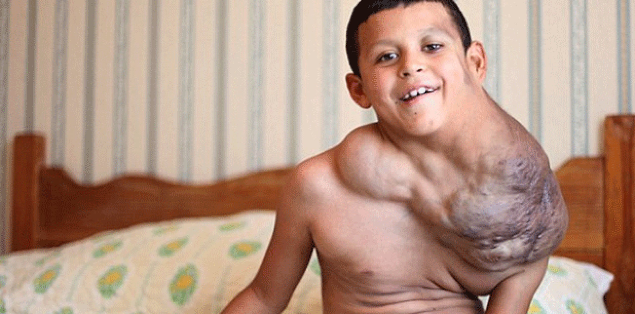 El crecimiento del tumor de José Antonio Ramires Serrano, de Ciudad Juárez, México, es potencialmente mortal, bloque parcialmente su tráquea y pone presión sobre su corazón y pulmones. (DailyMail)