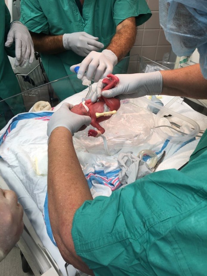 Dan de alta a bebé que pesó solo 13 onzas al nacer - Primera Hora