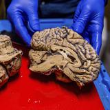 Hallan cobre y hierro elementales en el cerebro de dos pacientes de alzheimer