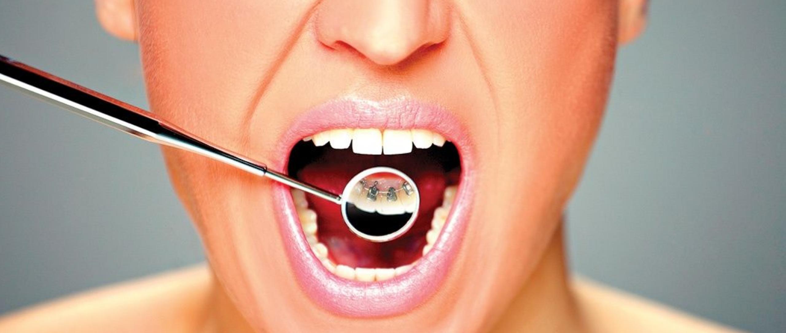 La ortodoncia lingual es una de las opciones para que no se vean los “brackets”, puesto que irán cementados en la parte de atrás del diente.