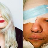 Transgénero comparte su impresionante cirugía de feminización facial