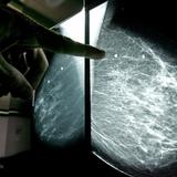 Hallan en hormonas masculinas posible clave contra el cáncer de mama