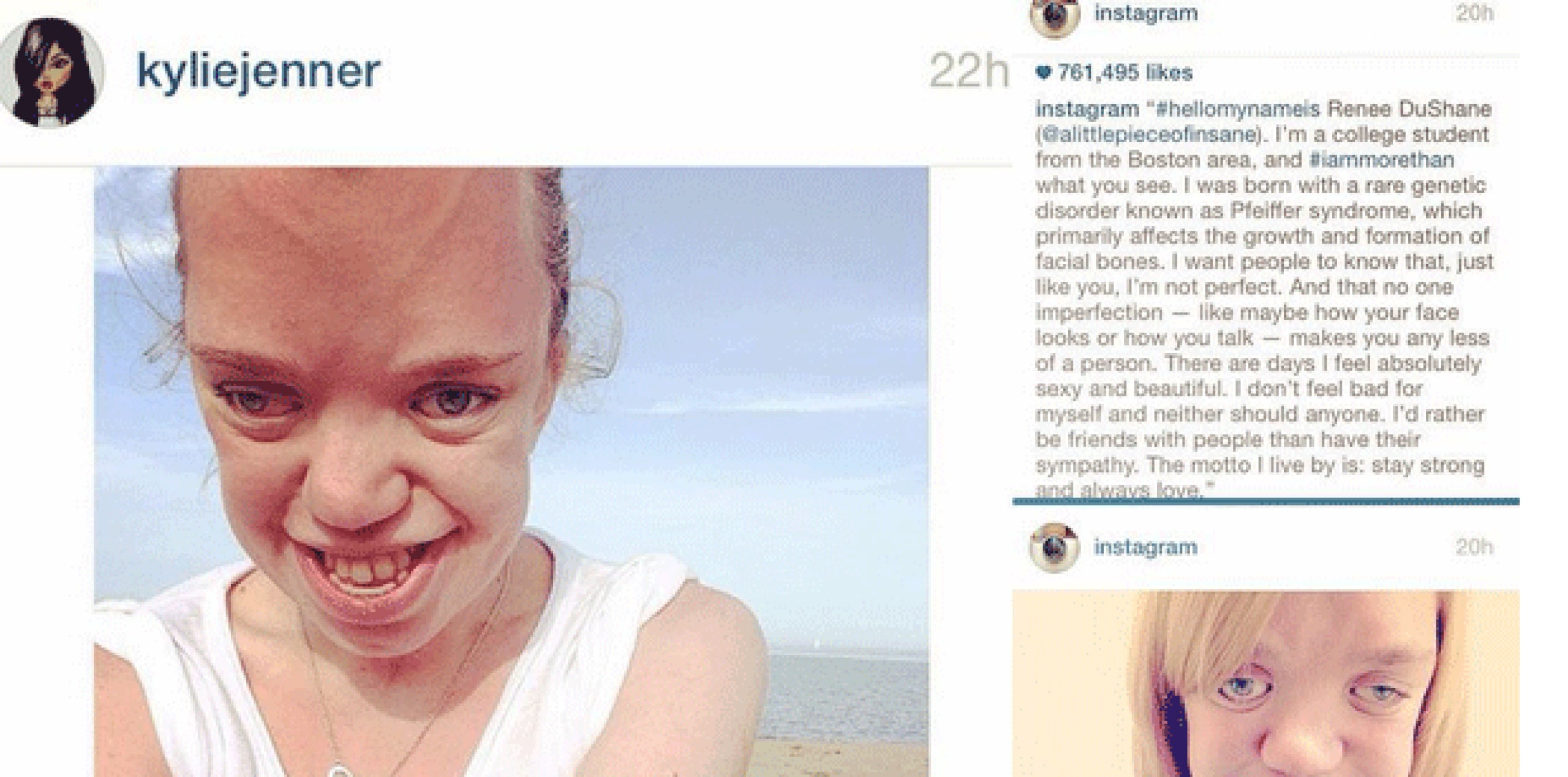 En una publicación en Tumblr, la joven de 18 años de edad, narra como su condición, además de problemas médicos, la ha llevado a padecer depresión, a sufrir trastornos alimenticios y a someterse a "cosas horribles" con tal de lucir bonita. (Instagram)
