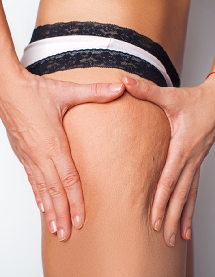 6 Alimentos Que Producen Mas Celulitis Primera Hora
