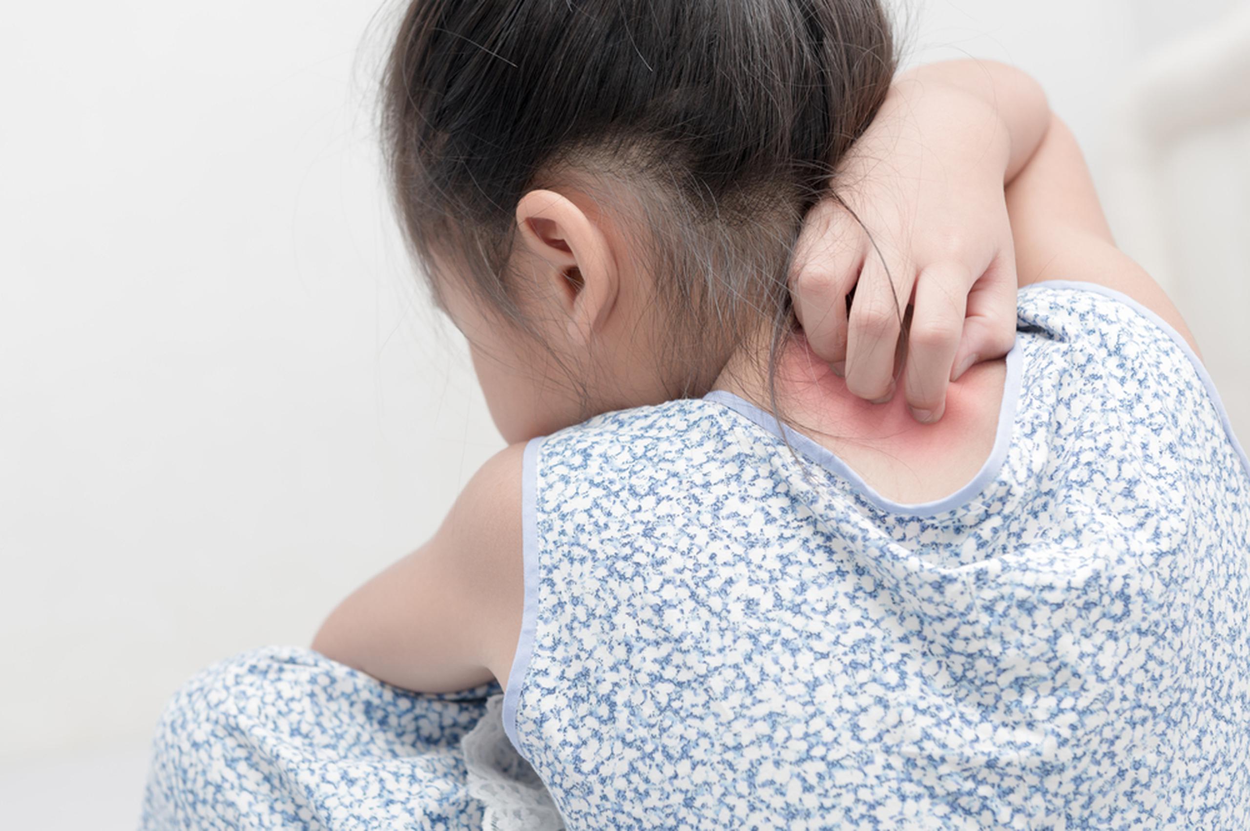 El tipo de psoriasis más común en los niños es la psoriasis vulgar.