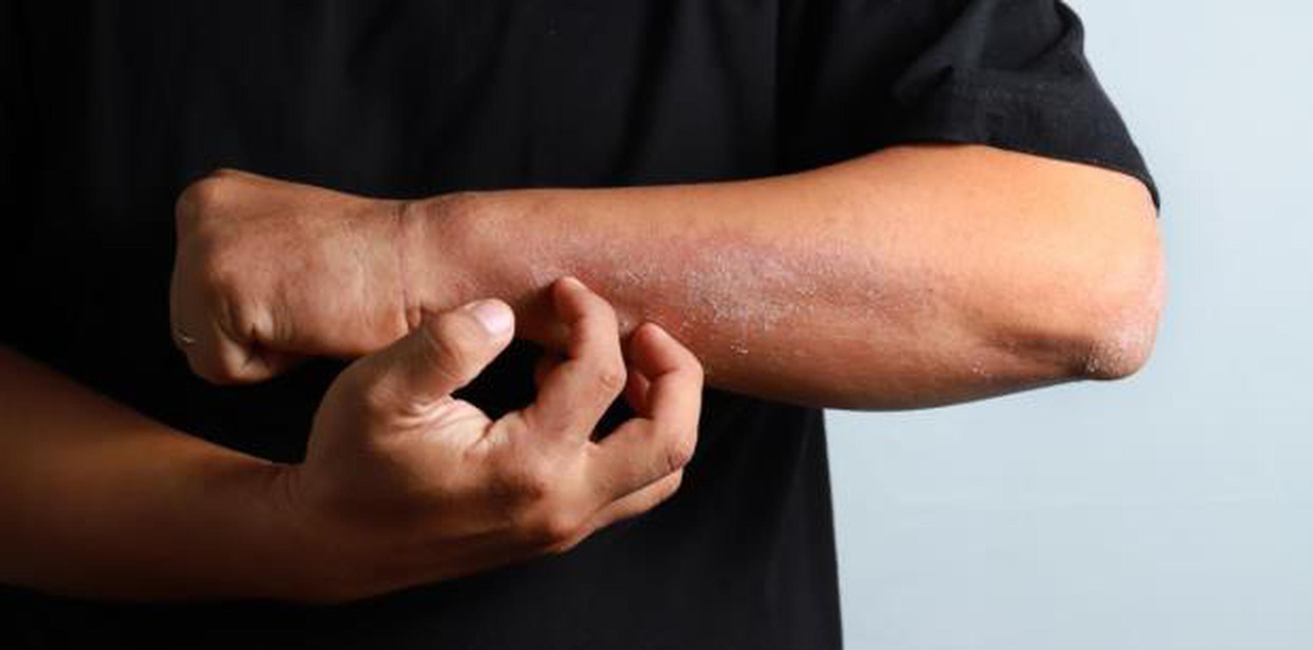 La dermatitis atópica es considerada una enfermedad rara o difícil de tratar que afecta a 3 % de los adultos. (Shutterstock)