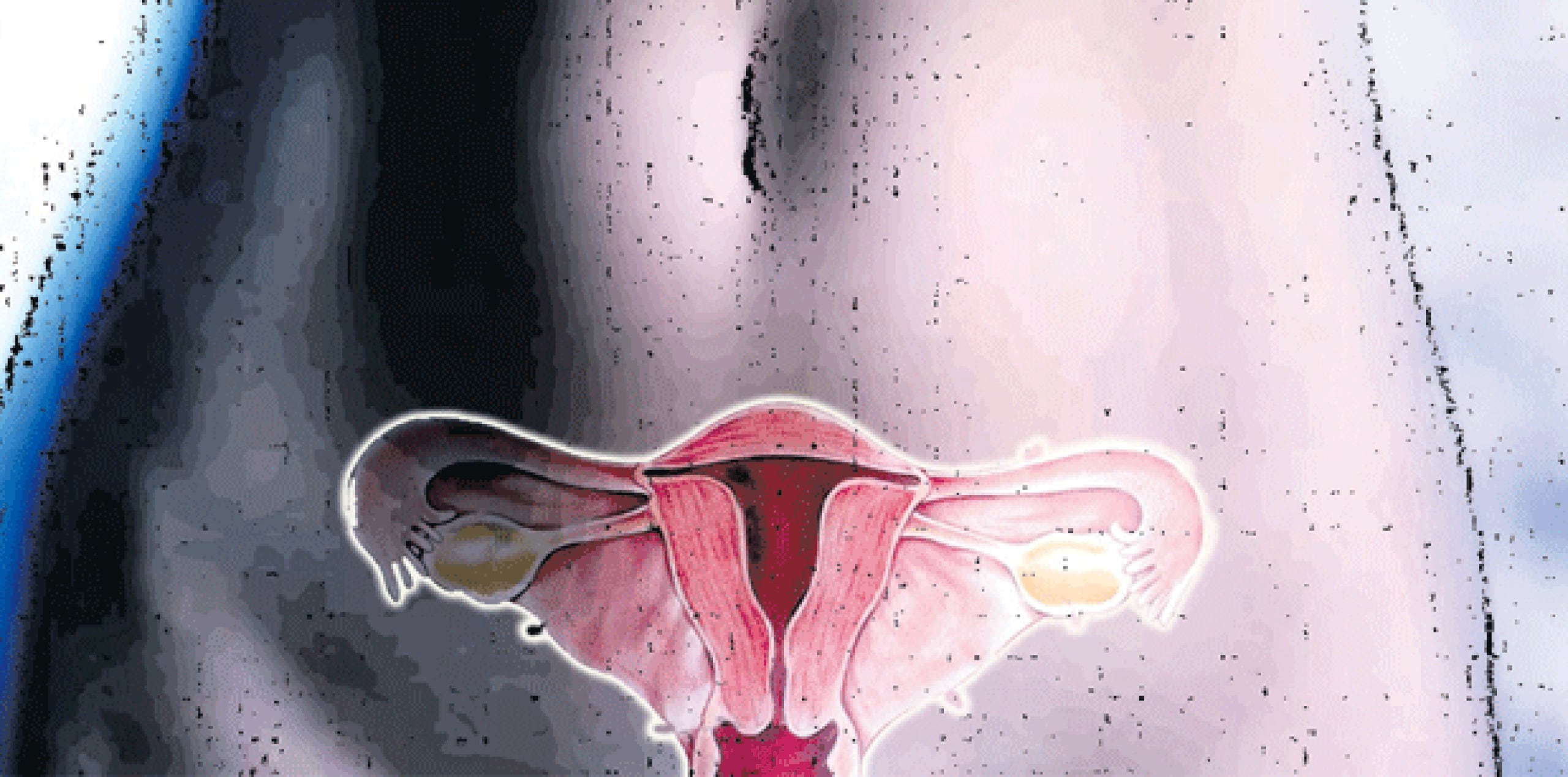 El cáncer de ovario es el noveno en la lista de los que afectan a las mujeres, según estadísticas recopiladas por el Registro Central de Cáncer de Puerto Rico entre 2006 a 2010. El primero es el cáncer de mama, seguido por el de colon y recto y el de tiroides. (Archivo)