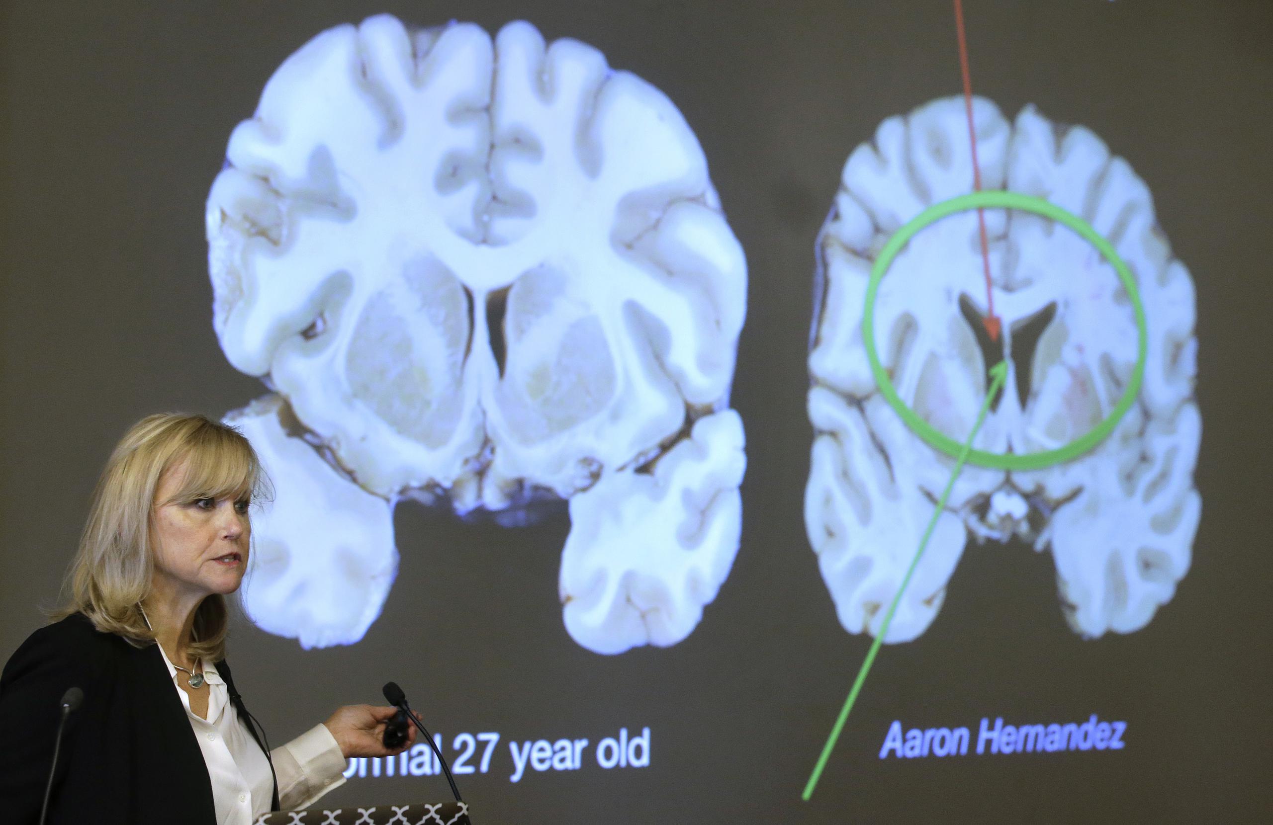 La doctora Ann McKee mostrando los resultados del estudio de Aaron Hernández. (AP / Steven Senne)
