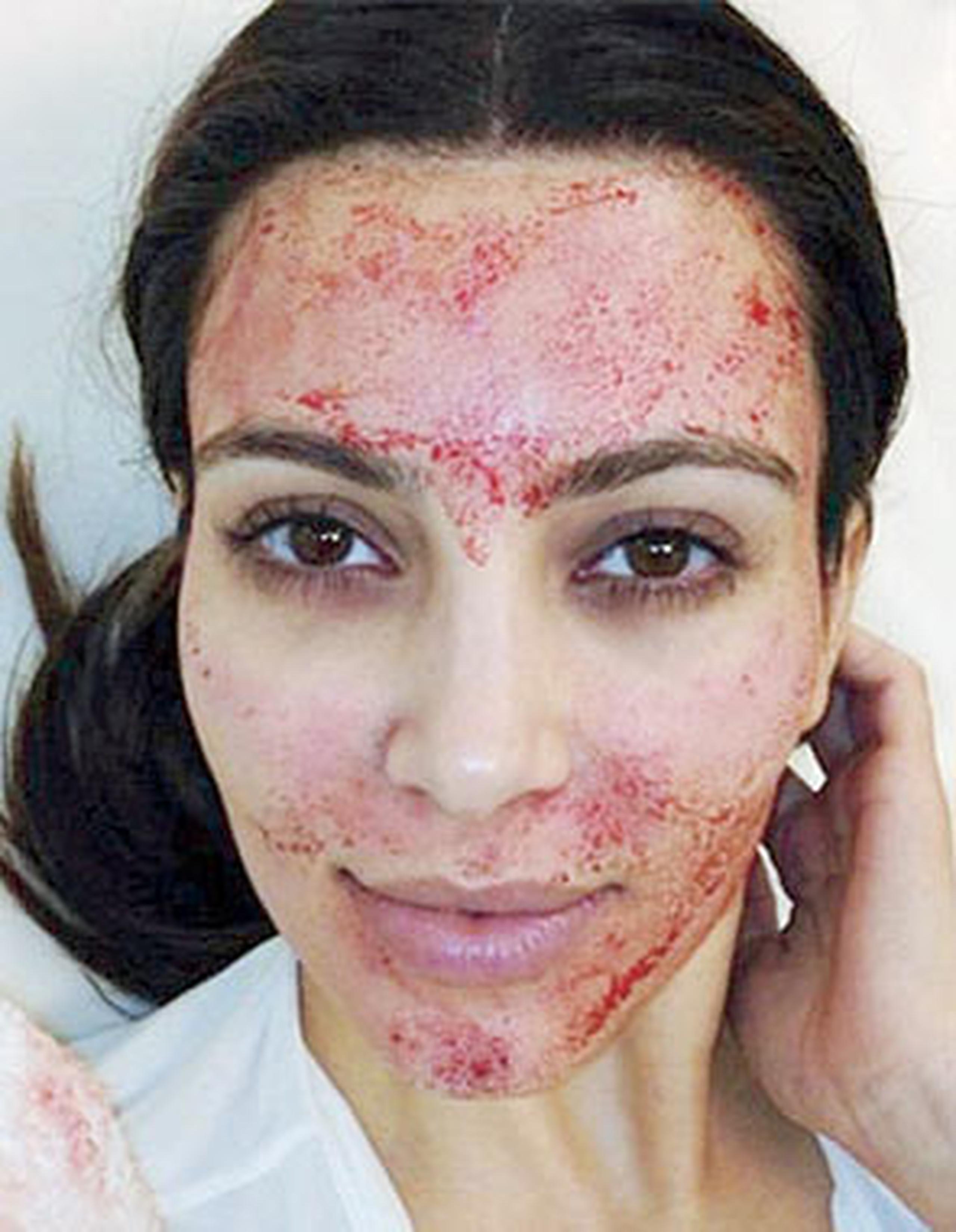 Kim Kardashian recibió duras críticas cuando publicó una foto aplicándose el tratamiento que regenera la producción de células. (Archivo)
