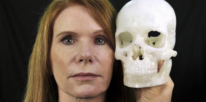 Pamela Shavaun Scott sostiene un modelo de tamaño natural del cráneo de ella, con todo y tumor. (AP/Phil Klein)