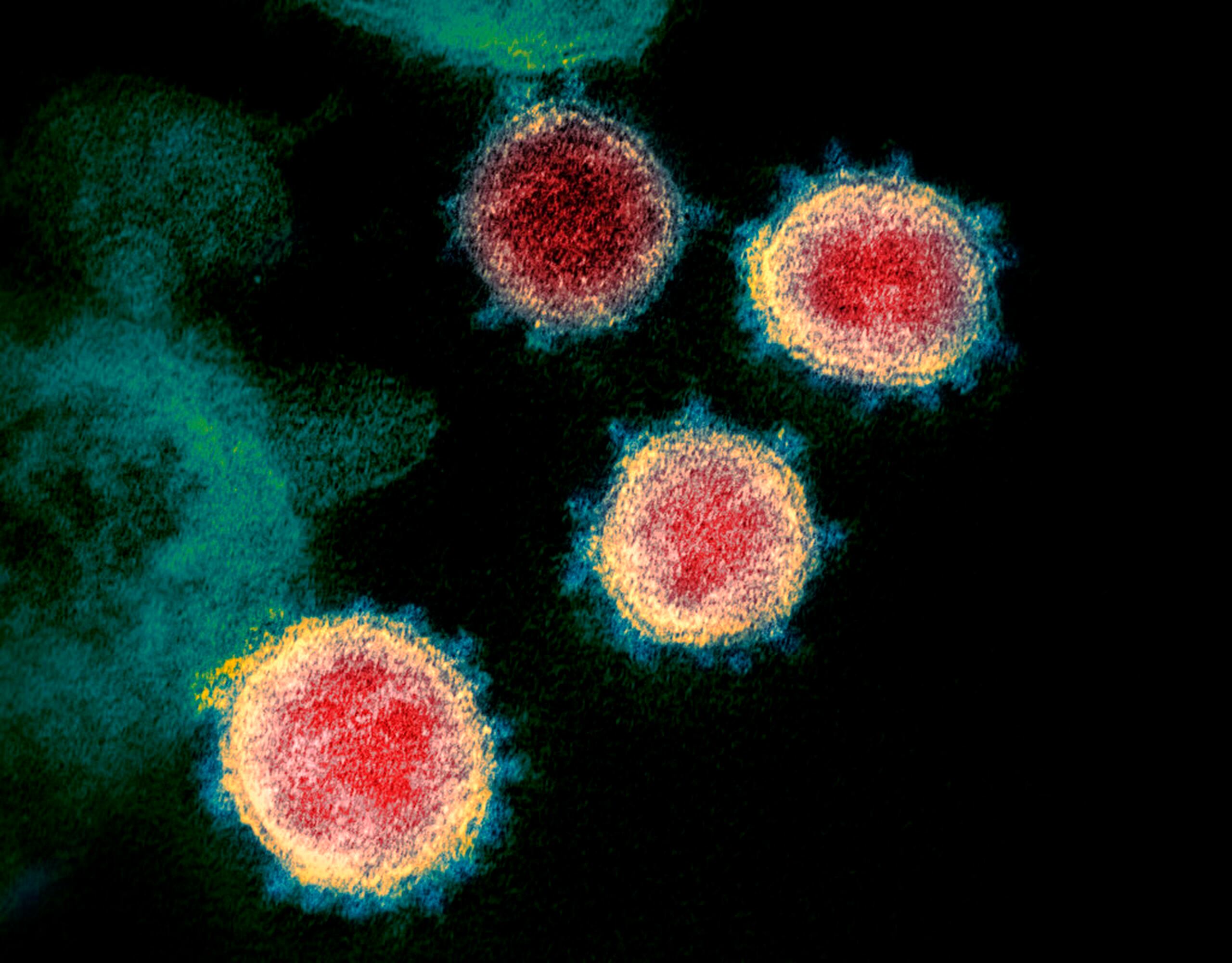 Imagen de microscopio electrónico que muestra el coronavirus que causa la enfermedad COVID-19.