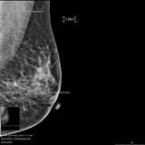 Mamografía 3D-tomosintesis: nueva herramienta de evaluación para la detección temprana del cáncer de seno