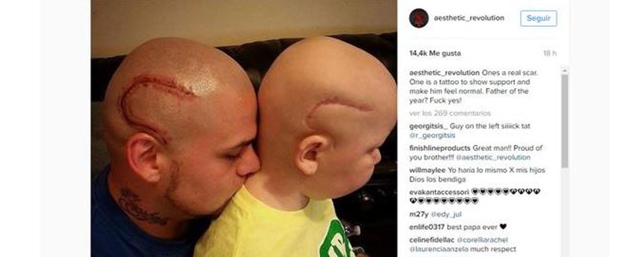 Josh Marshall explicó a ABC News que su hijo Gabriel, de 8 años, se quedó calvo y con una gran cicatriz curva en el lado derecho de la cabeza tras una operación para extirparle un tumor cerebral. (Instagram)