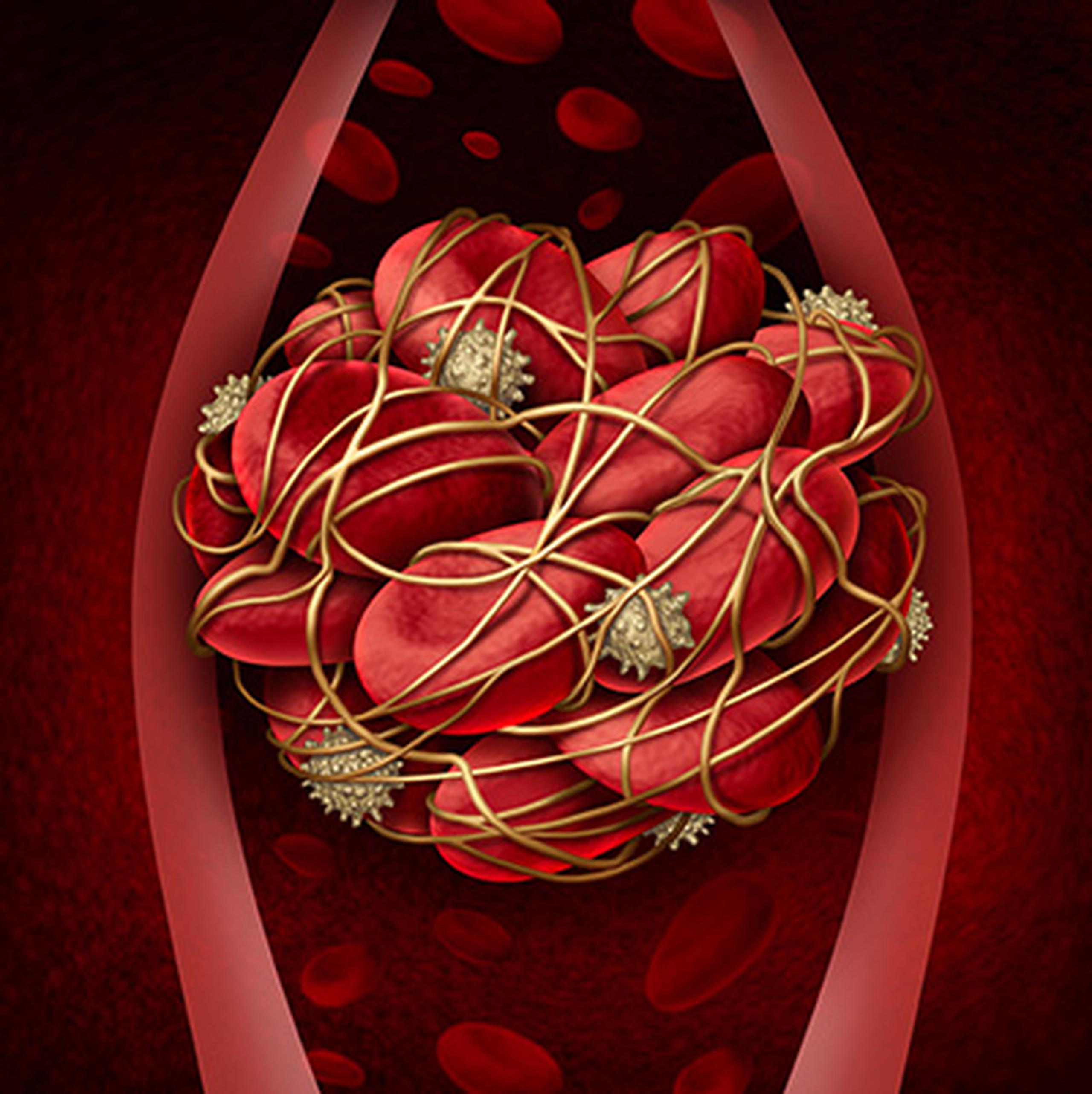 Ilustración de un coágulo de sangre proporcionada por los Centros para el Control y la Prevención de Enfermedades de los Estados Unidos.