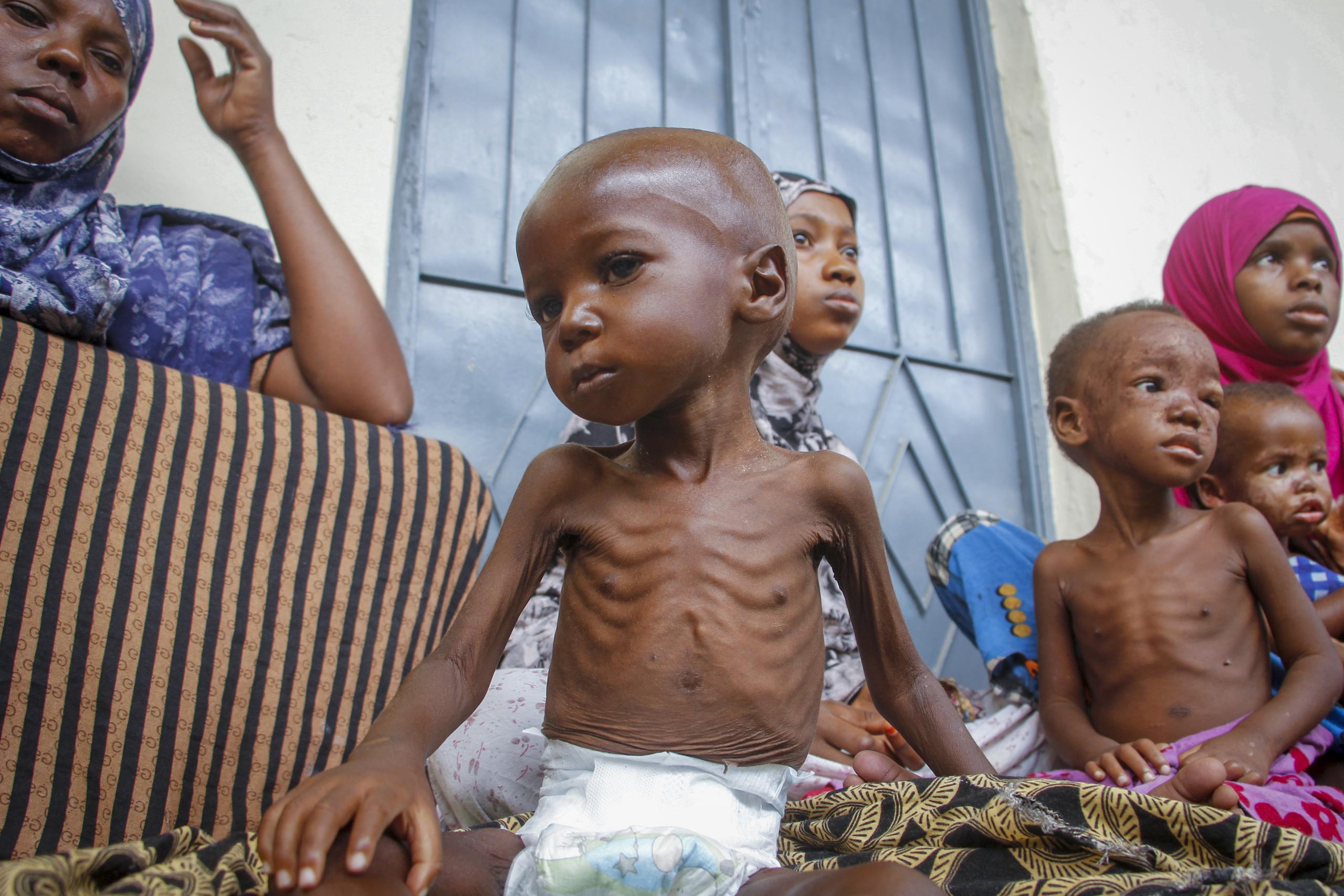 Un niño desnutrido de dos años, sentado junto a su madre, desplazados por la sequía en un centro para la desnutrición gestionado por Acción contra el Hamnre, en Mogadiscio, Somalia, el 5 de junio de 2022. Datos inéditos compartidos con The Associated Press muestran que al menos 448 personas murieron este año en los centros de tratamiento de la desnutrición solo en Somalia. (AP Foto/Farah Abdi Warsameh)
