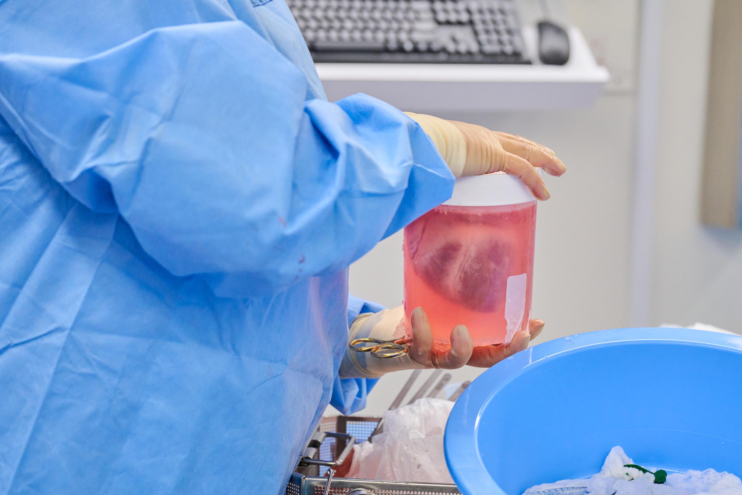Un corazón de cerdo modificado genéticamente suspendido en una solución antes del xenotrasplante en NYU Langone Health el 6 de julio de 2022.