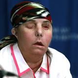 Realizan segundo trasplante de cara a una mujer en EE.UU.
