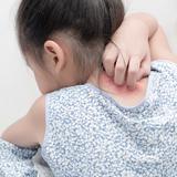 Conoce las causas de la psoriasis en los niños y su tratamiento