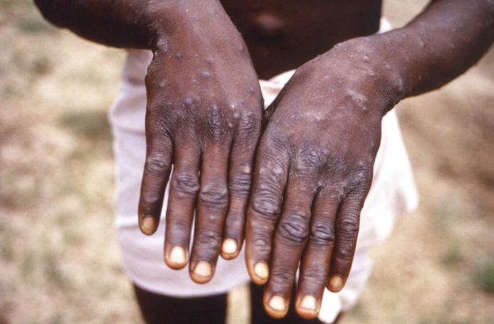 Esta imagen de 1997 proporcionada por los CDC durante una investigación sobre un brote de viruela del mono, que tuvo lugar en la República Democrática del Congo, muestra las superficies dorsales de las manos de un paciente con un caso de viruela del mono.