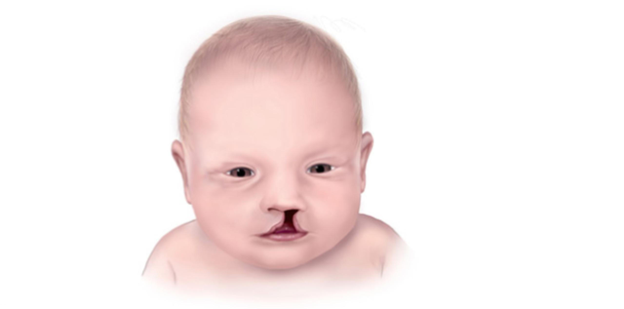 Los bebés con trisomía 13 suelen tener labio leporino o labio hendido. (U.S. National Library of Medicine)