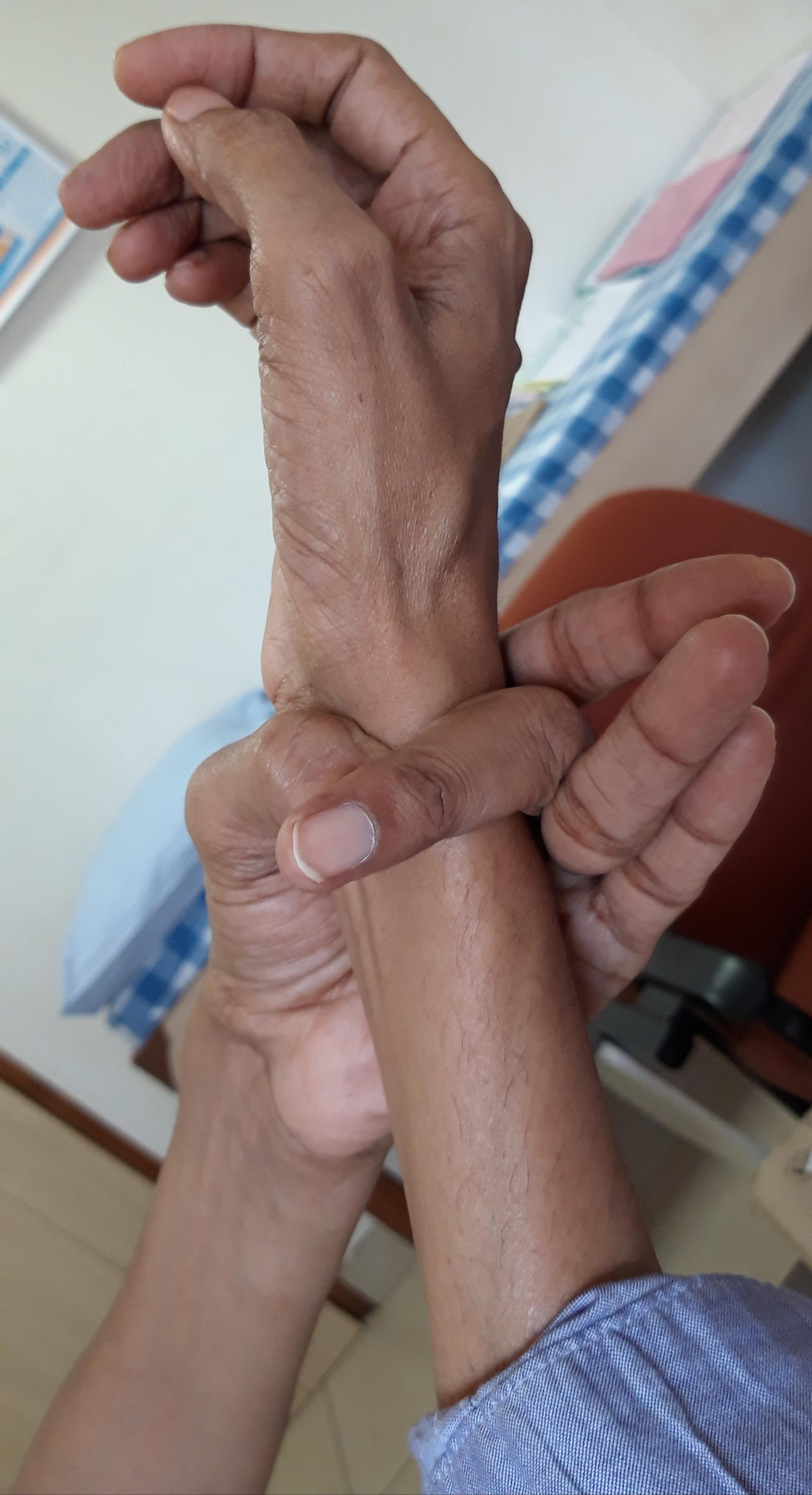 Algunas características comunes asociadas con el síndrome incluyen una contextura alta y delgada, con los dedos de manos y pies desproporcionadamente largos y delgados. 