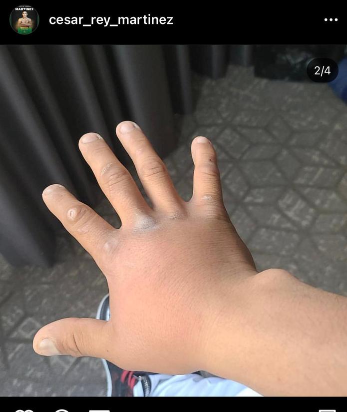 El púguil mexicano publicó en las redes sociales una imagen demostrando la inflamación en la mano derecha.