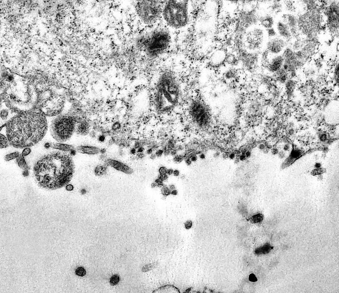 Microscopio electronico de transmision imagenes de celulas,Captan Momento Exacto En Que El Coronavirus Infecta Una Celula Primera Hora