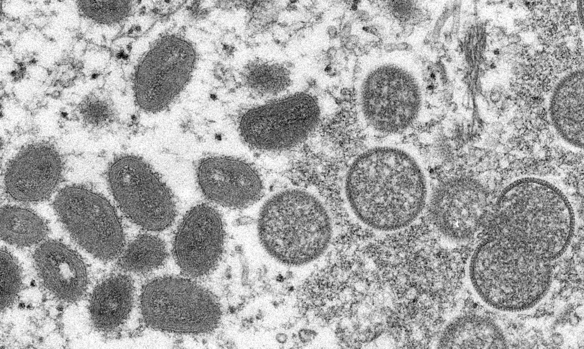 Israel relata seu primeiro caso de varíola