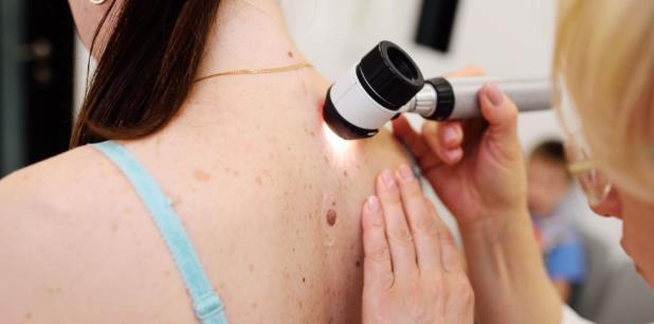 El cáncer de piel es el tipo de cáncer más común en el mundo. (Shutterstock)