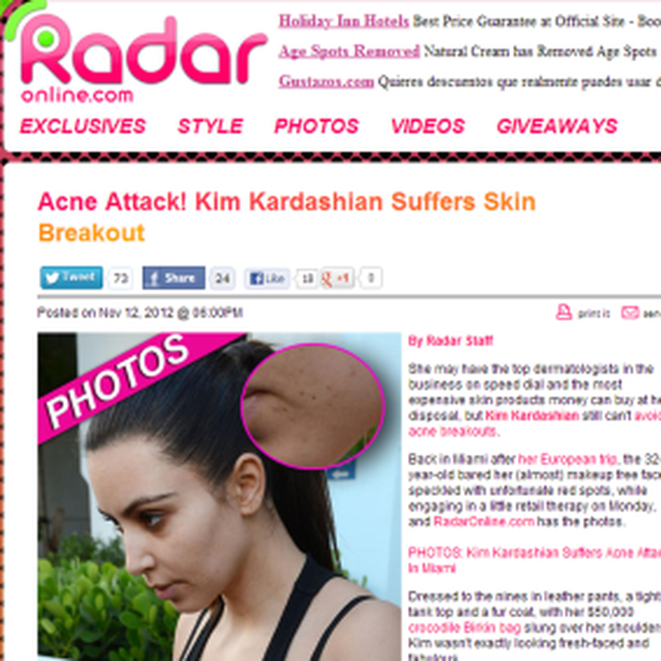 La estrella esta vez no suavizó su piel con maquillaje para tapar su acné. (Radar Online)