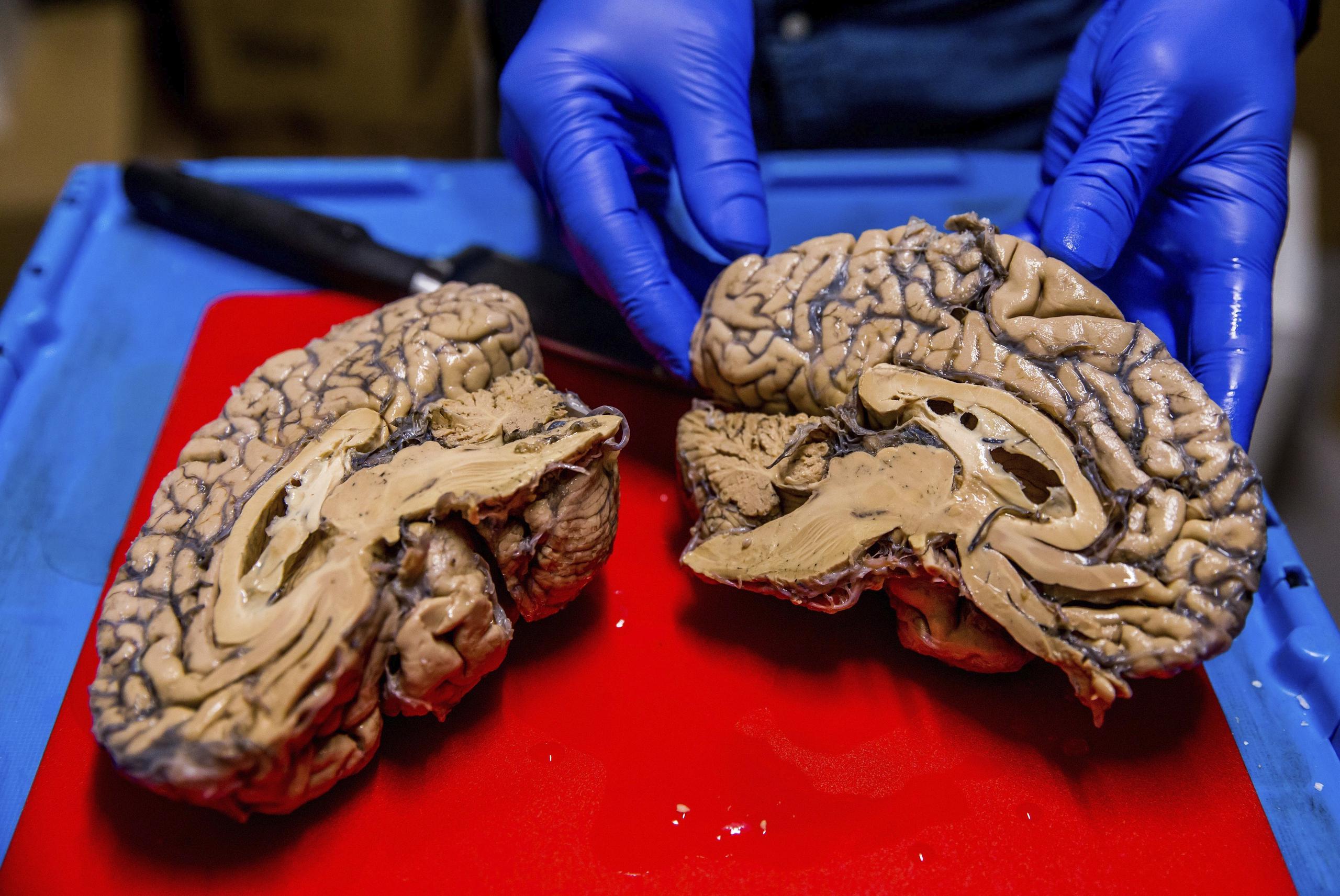 Un cerebro partido en dos tras una disección.