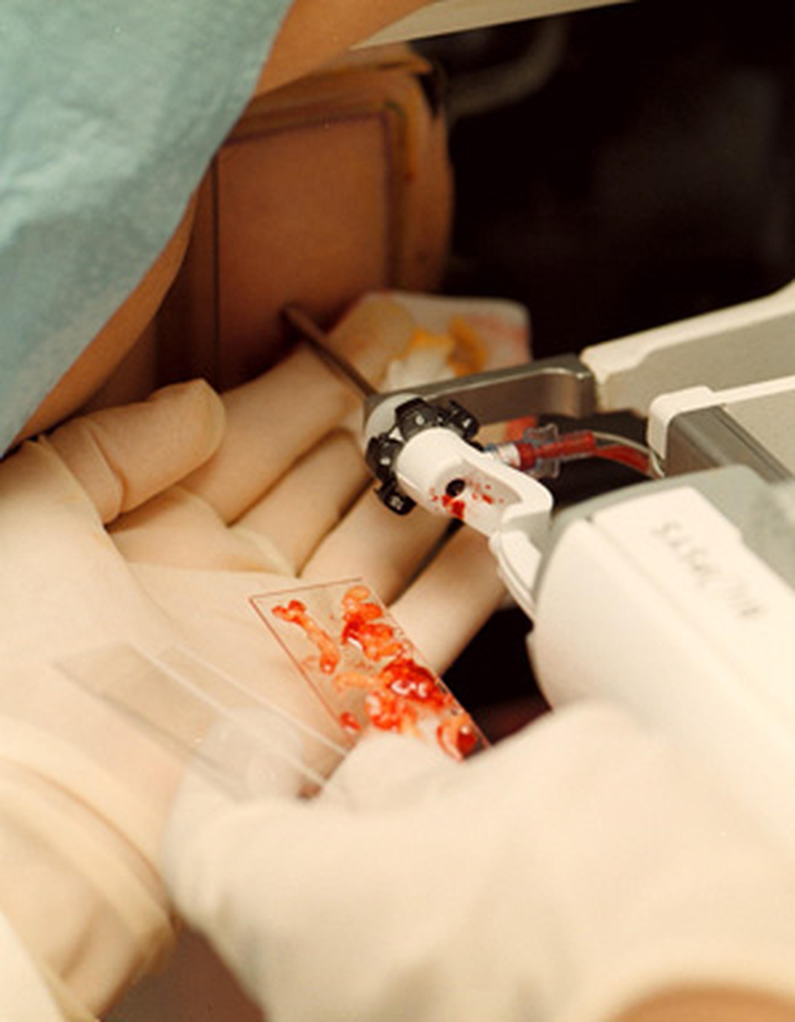 Las biopsias líquidas evitarían que algunos pacientes se sometan a cirugías con largas agujas. (Archivo)
