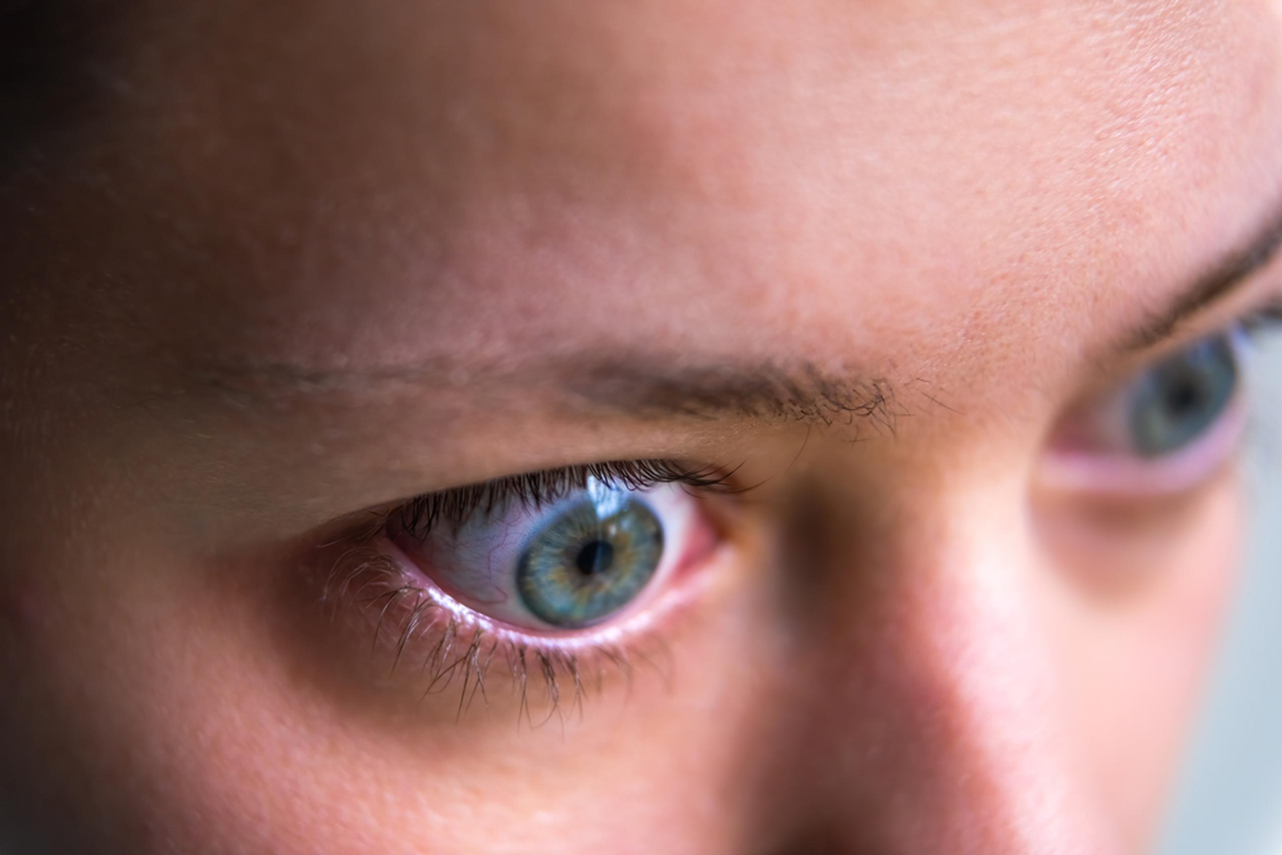 Varios factores pueden aumentar el riesgo de desarrollar enfermedad tiroidea de los ojos en ciertos pacientes, entre los que se encuentran: el factor genético, su género, una edad avanzada y altos niveles de estrés.