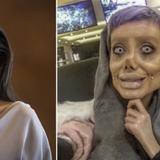 Joven se habría hecho más de 50 cirugías para verse como Angelina Jolie