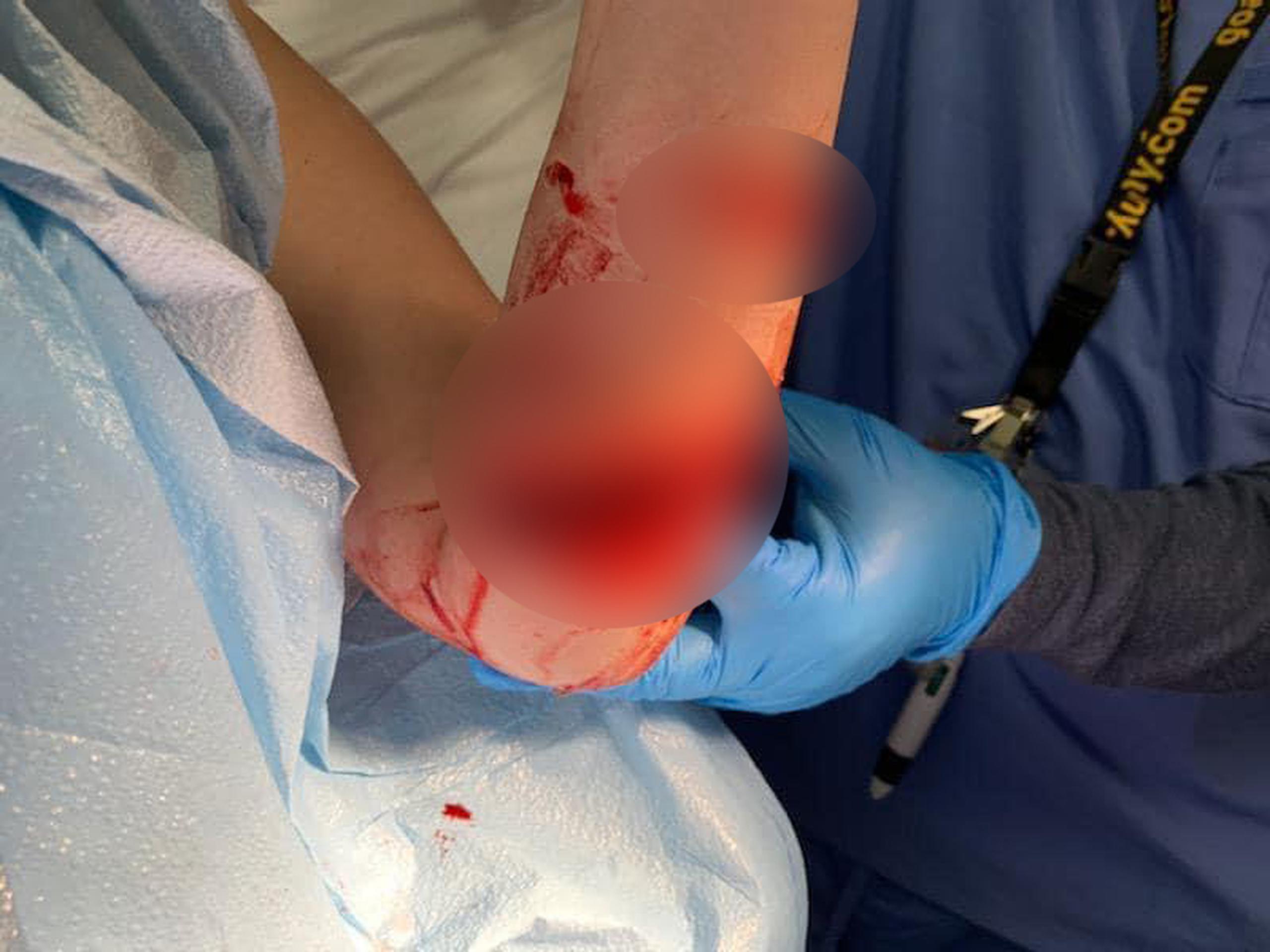 Herida de joven de 20 años en su brazo izquierdo tras la mordida de un pez en la playa Combate en Cabo Rojo.