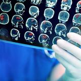Lo que debes saber sobre el ataque cerebral o “stroke”