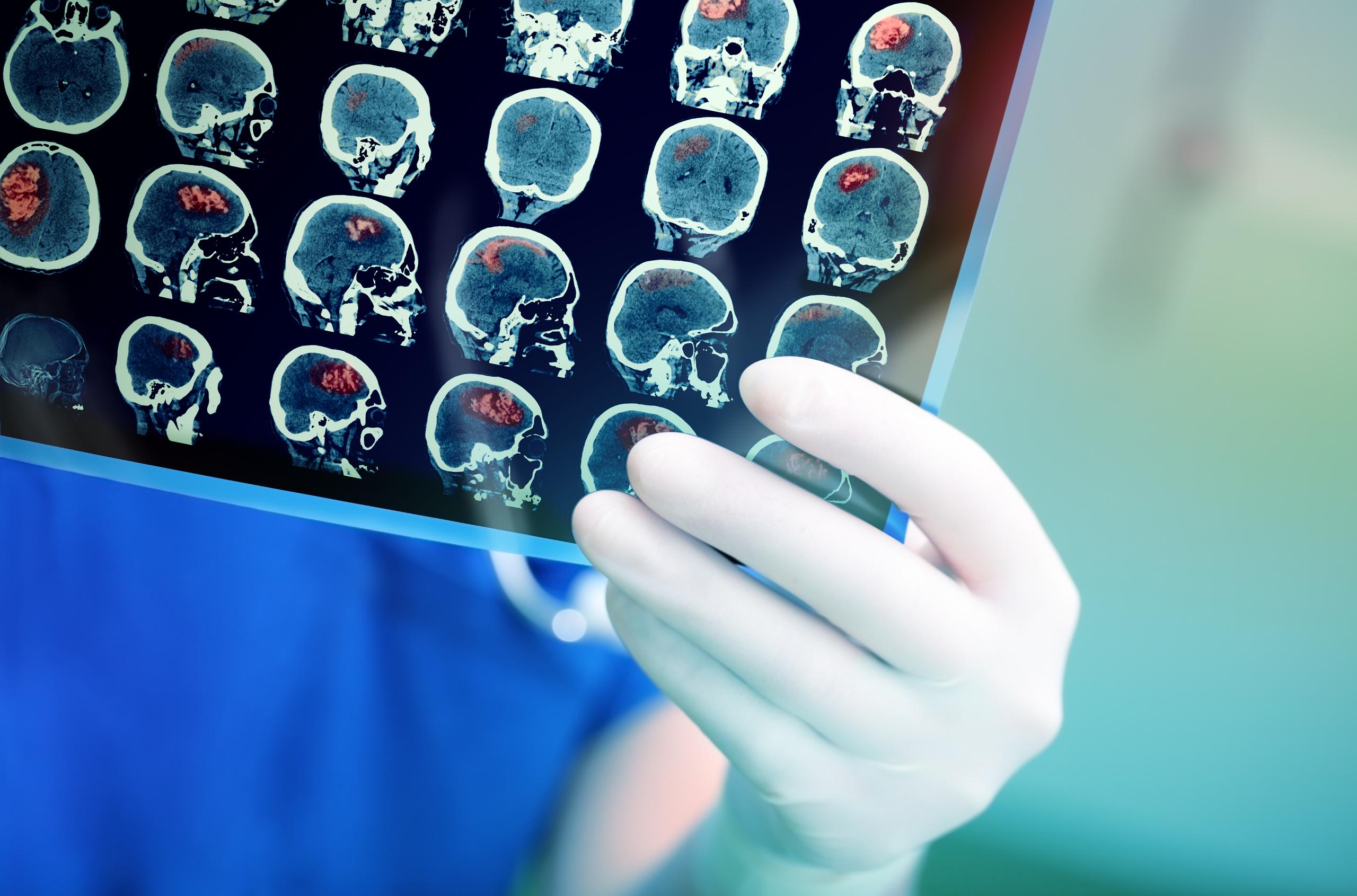 Para el manejo agudo del ataque cerebral hay una ventana terapéutica de 4.5 horas para dar medicación intravenosa trombolítica que disuelva los coágulos o trombos de las arterias cerebrales, siempre y cuando no haya sangrado o se reflejen —en CT o MRI— cambios que sugieran una isquemia irreversible.