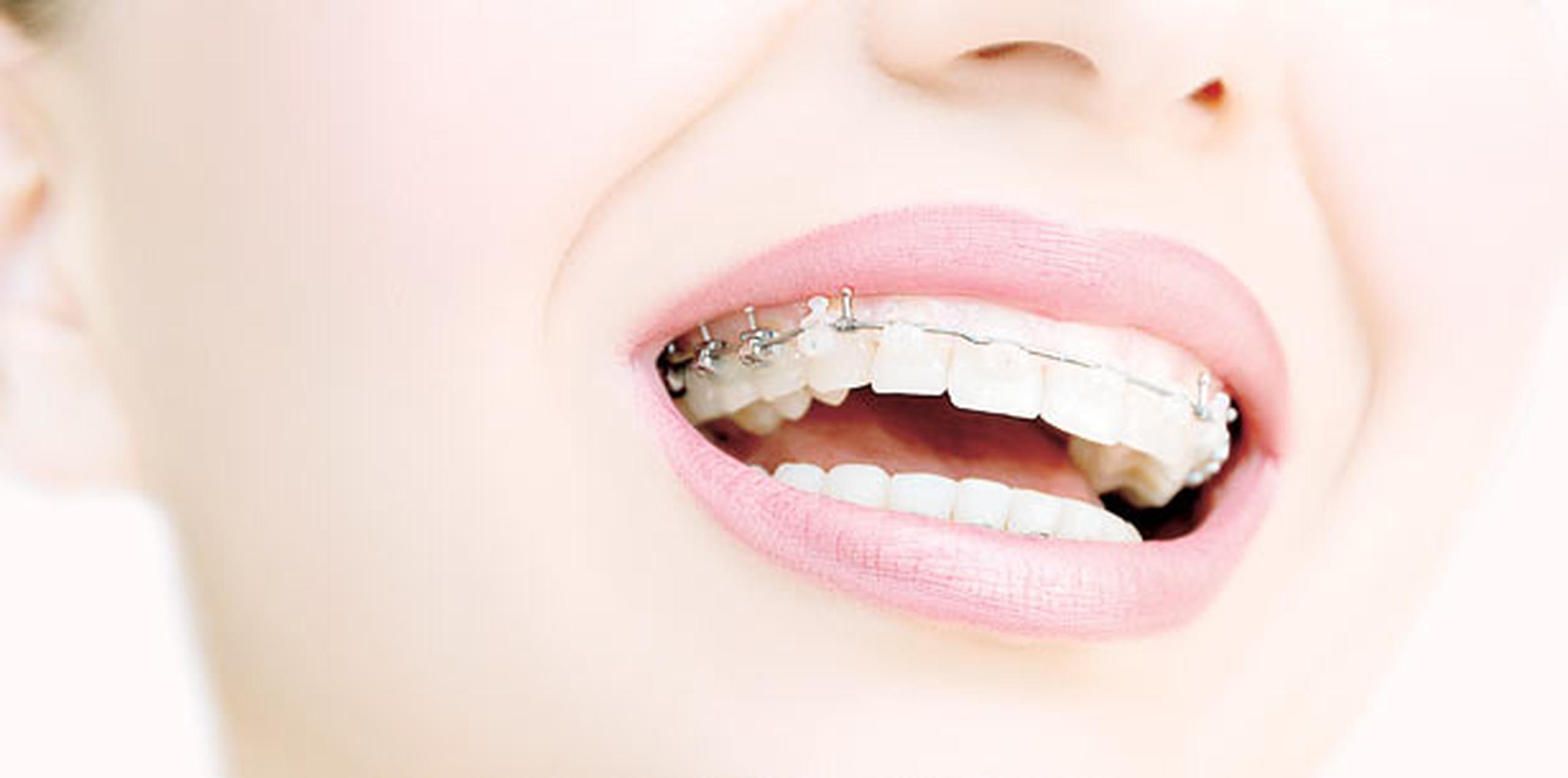 Los ortodoncistas aseguran la ortodoncia no tiene edad. (Archivo)