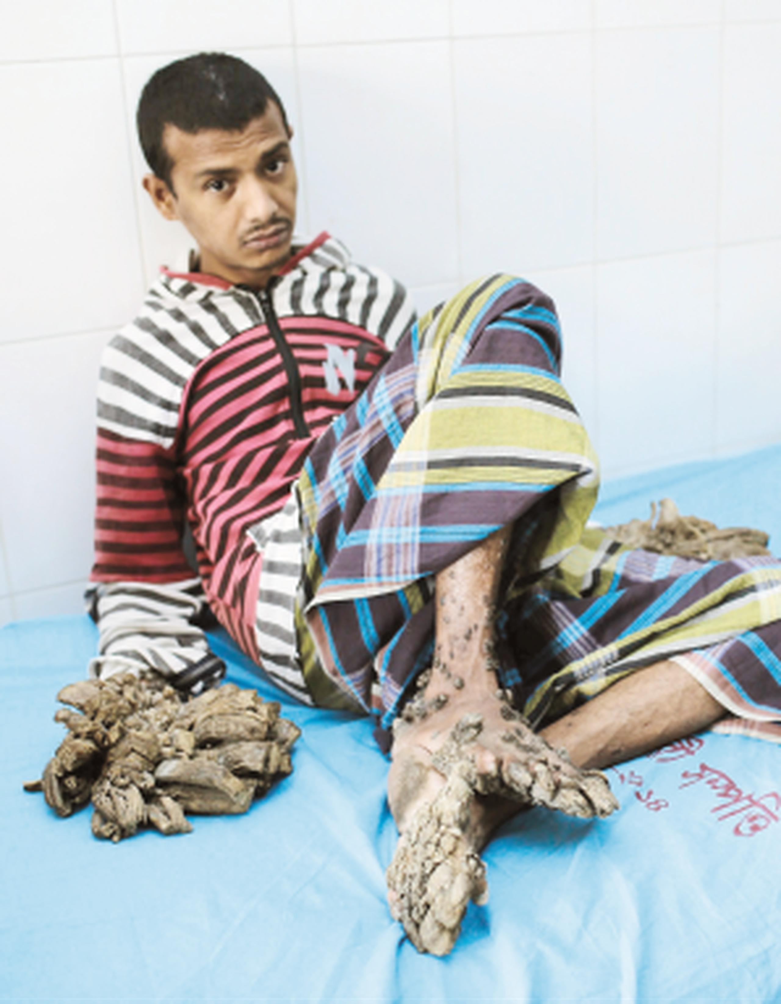 Abul Bajandar, conocido como "hombre-árbol", ha sido sometido a 16 operaciones para retirarle las enormes verrugas en forma de cortezas que afectaban sus manos y pies. (Archivo)