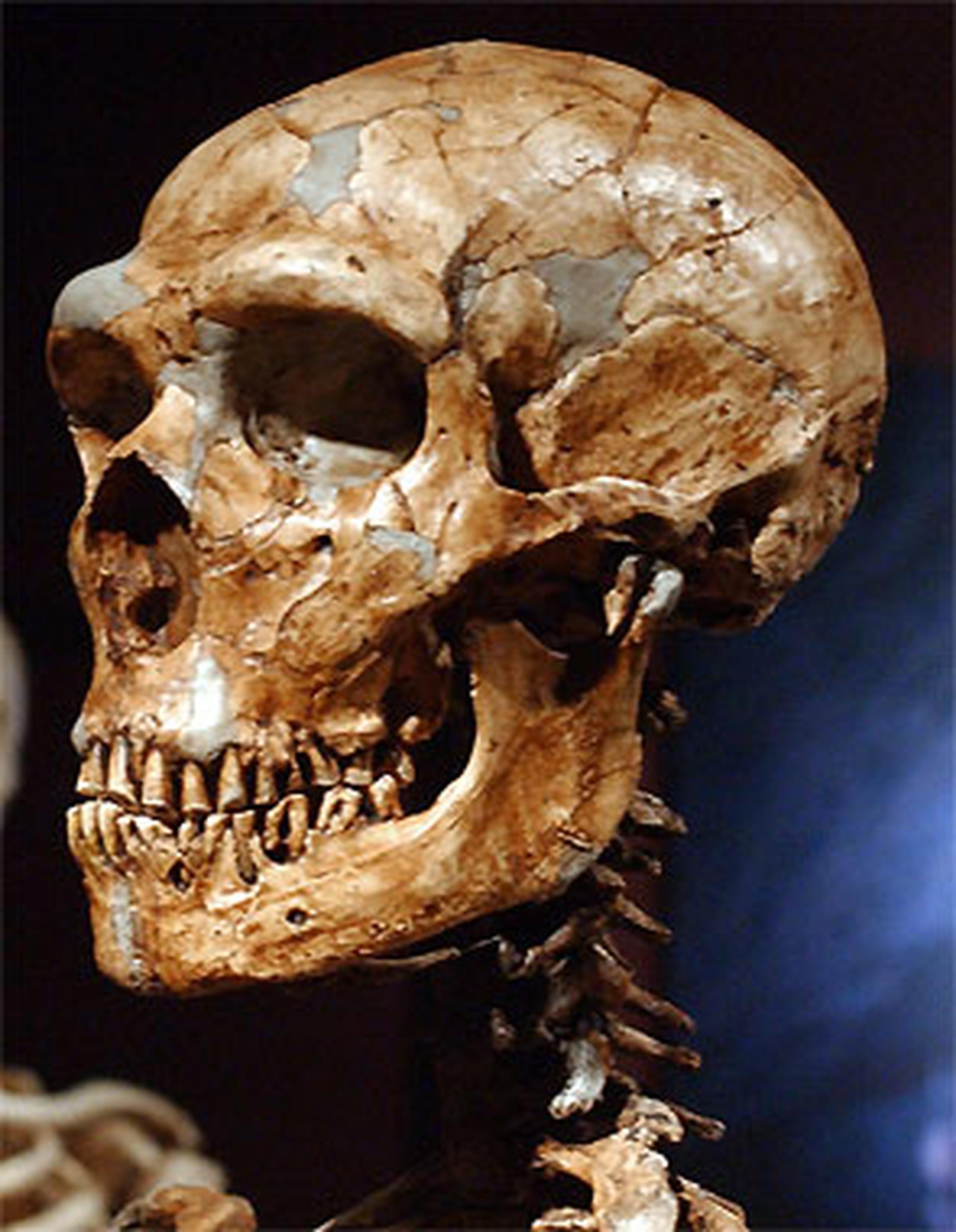 esqueleto de cáncer de hueso