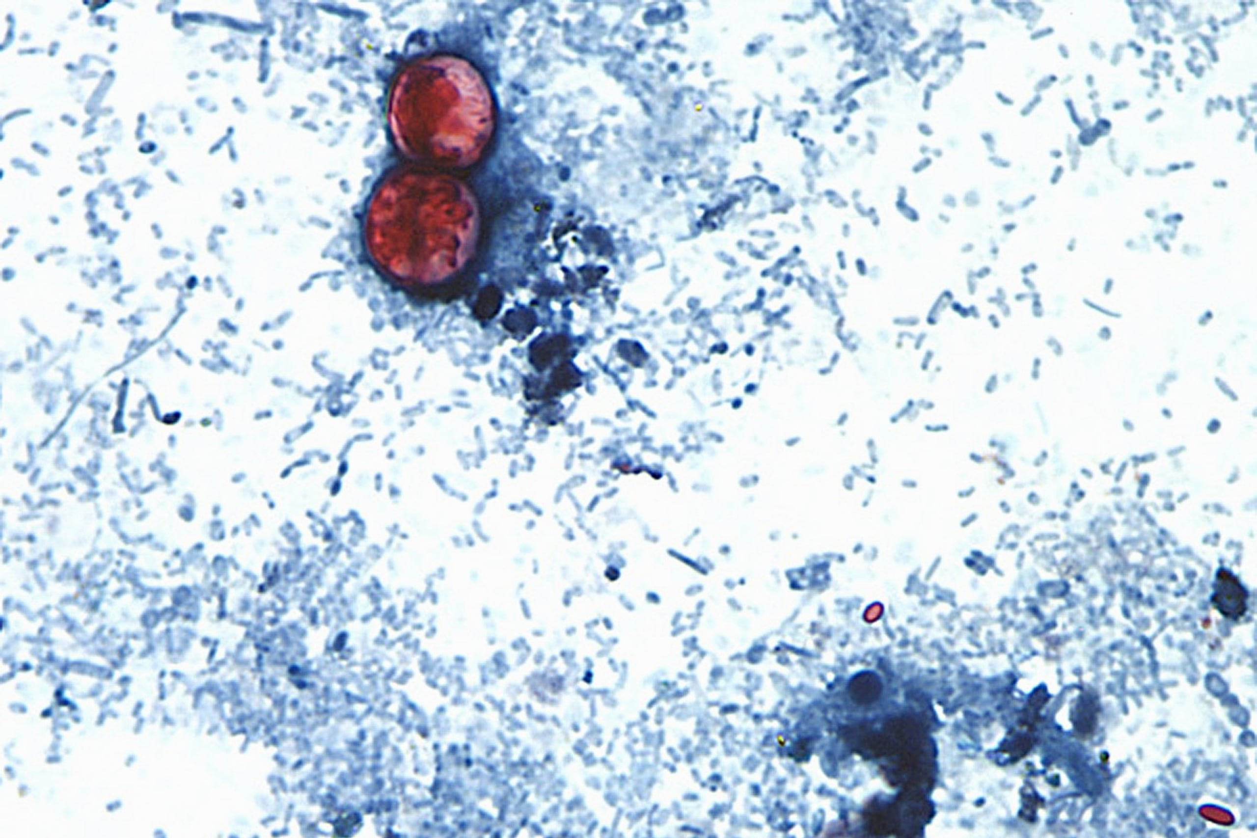FILE - This undated photo taken through a microscope provided by the CDC shows Cyclospora cayetanensis oocysts found in a fresh stool sample which had been prepared with a formalin solution and stained with safranin. (CDC via AP, File)