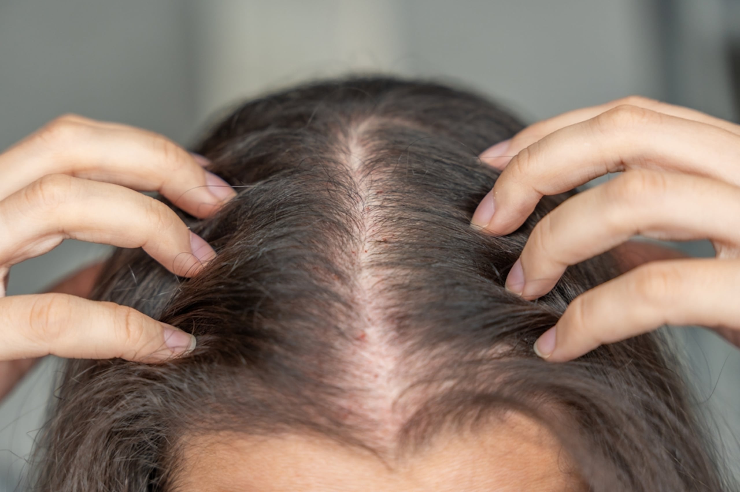 El estudio demostró un crecimiento del cabello temprano y sustancial, incluso cobertura completa del cuero cabelludo.
