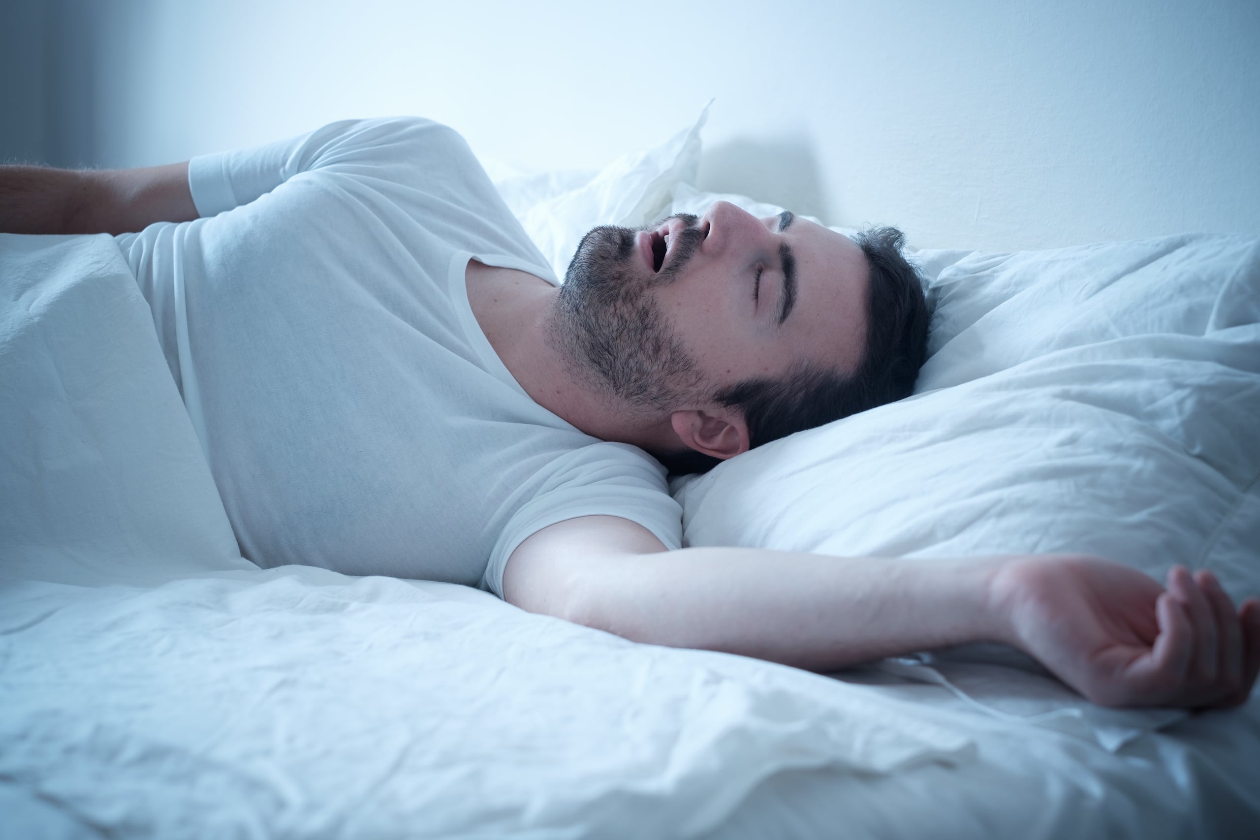 La apnea se trata de un trastorno relacionado con el sueño caracterizado por episodios repetidos de respiración irregular debidos a la obstrucción total o parcial de las vías respiratorias superiores.