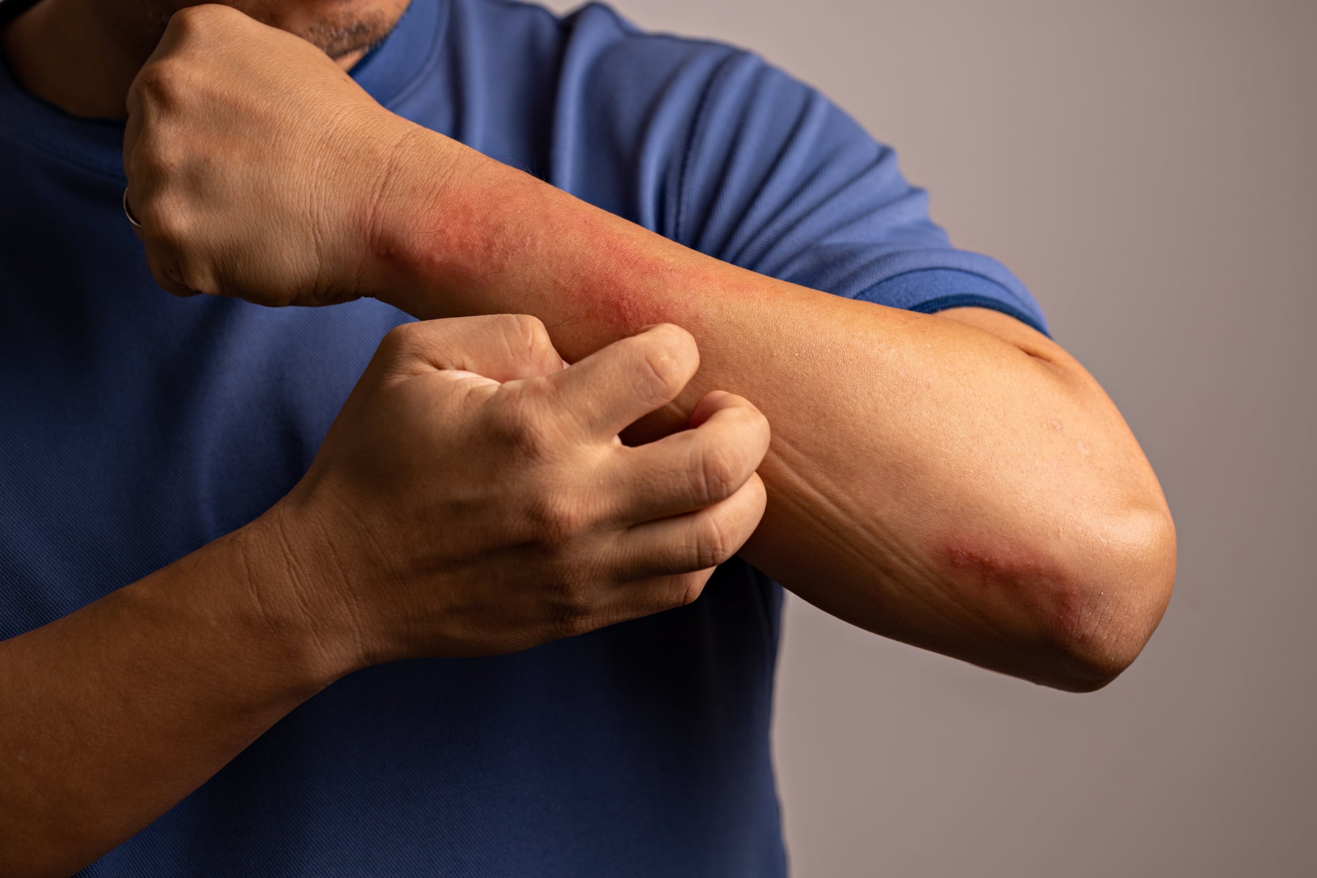 Una de las enfermedades para las que Alivia Specialty Pharmacy ofrece medicamentos especializados es la dermatitis atópica.